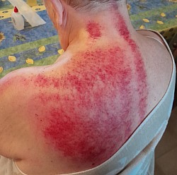 Massage Gua Sha à Bruxelles - Personne 81 ans