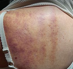 Massage Gua Sha - 24 heures plus tard - Personne 81 ans