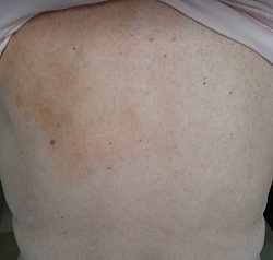 Massage Gua Sha au 4ième jour - Personne 81 ans