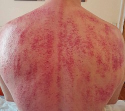 Traitement Massage Gua Sha Thaï Général - Bruxelles - Belgique